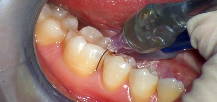 При лечении зубов ставят анестезию thumbnail