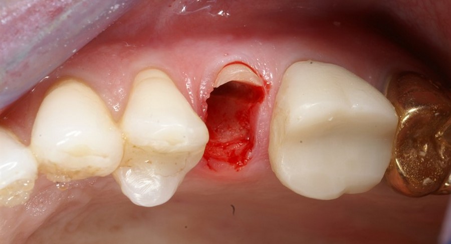 Лечение корня зуба видео thumbnail