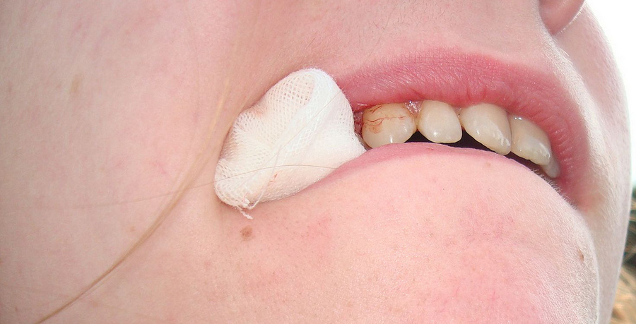 Осложнения после удаления корня зуба
