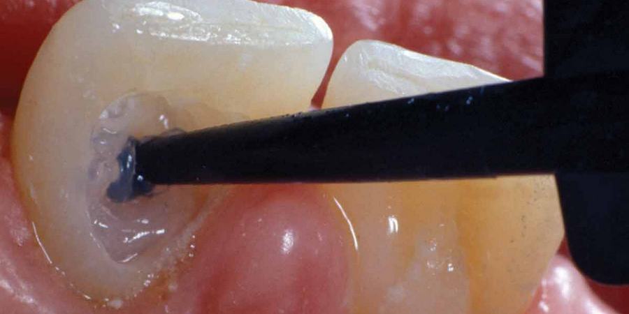 Отбеливания зубов противопоказания и возможные осложнения thumbnail