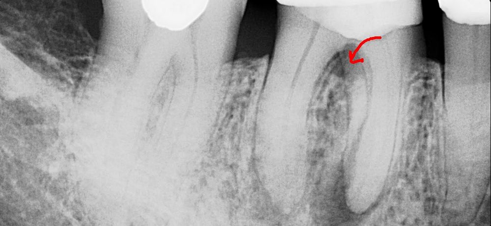 Перфорация в зубе его лечение thumbnail
