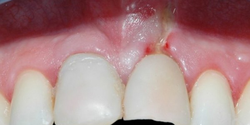 Виды перфорации зубов