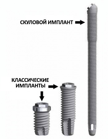 Сравнение классических и скуловых имплантов