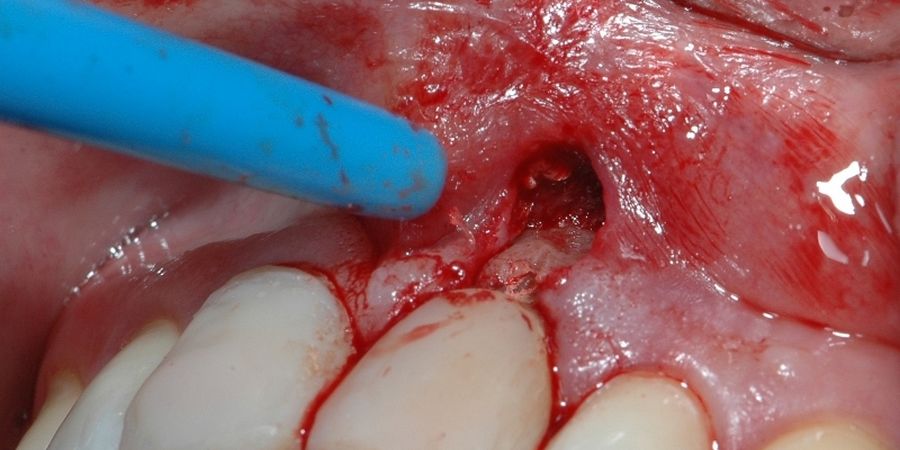 Негативные последствия перфорации зуба