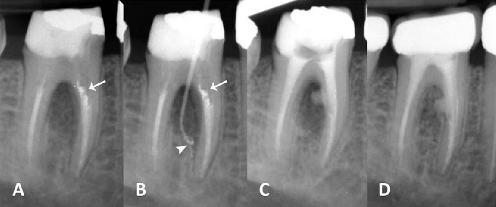 Диагностика и лечения перфорации зуба