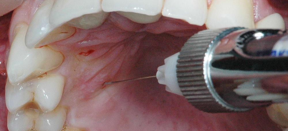 Хирургический метод лечения перфорации зуба
