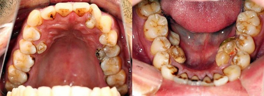 Дистопированные зубы верхней и нижней челюстях