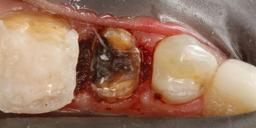 Зуб разрушился под коронкой за 30 лет