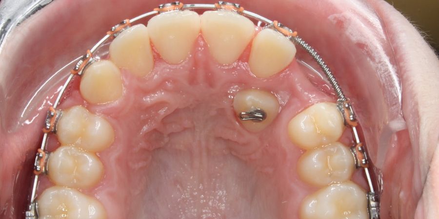 Исправление ретенции зубов при помощи брекетов