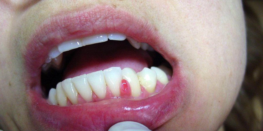 Болит зуб с гранулемой thumbnail