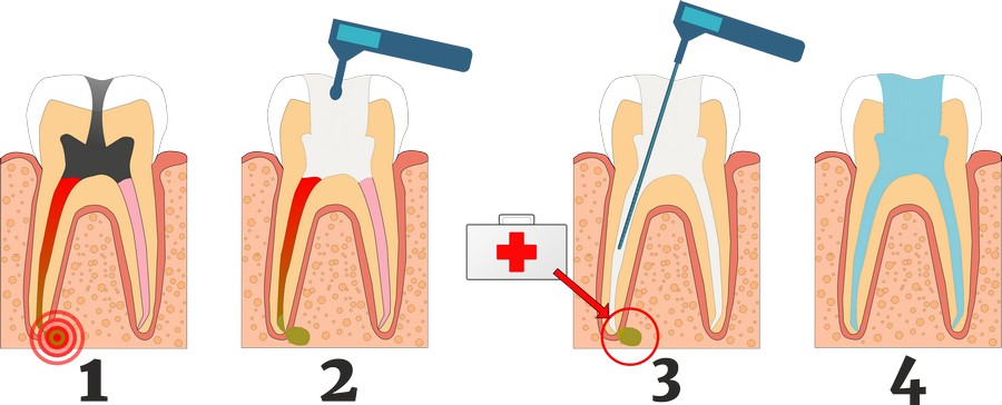 этапы лечения гранулемы зуба