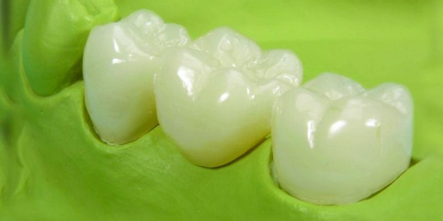 Как проявляется аллергия на металлокерамические зубы thumbnail