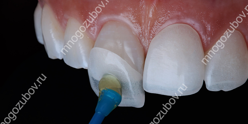 Лечение зуба после снятия коронки thumbnail